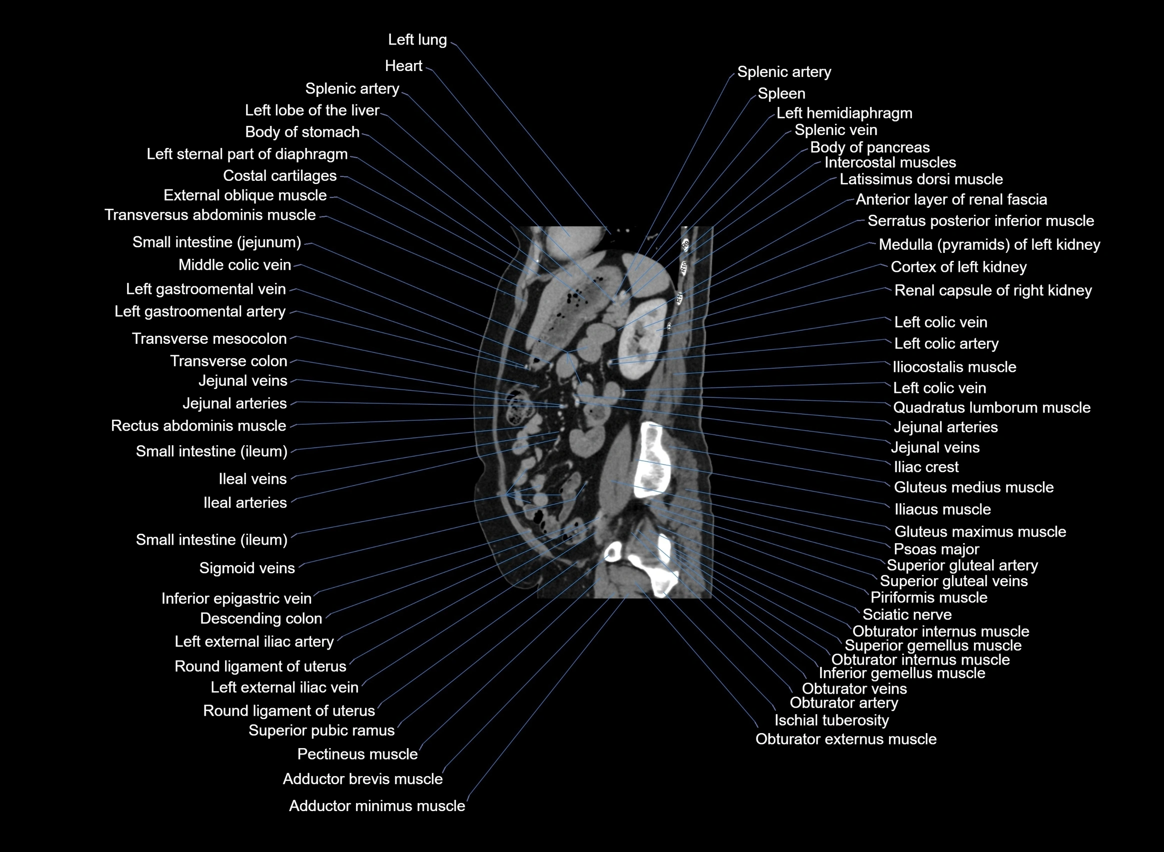 CT Abdomen sagittal cross sectional anatomy labelled radiology image -00038.webp